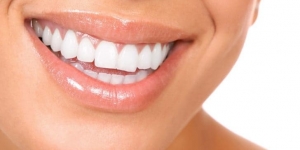 Современная безопасная процедура отбеливания зубов